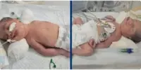 خاتون کی موت کے بعد جڑواں بچوں کی زندہ پیدائش